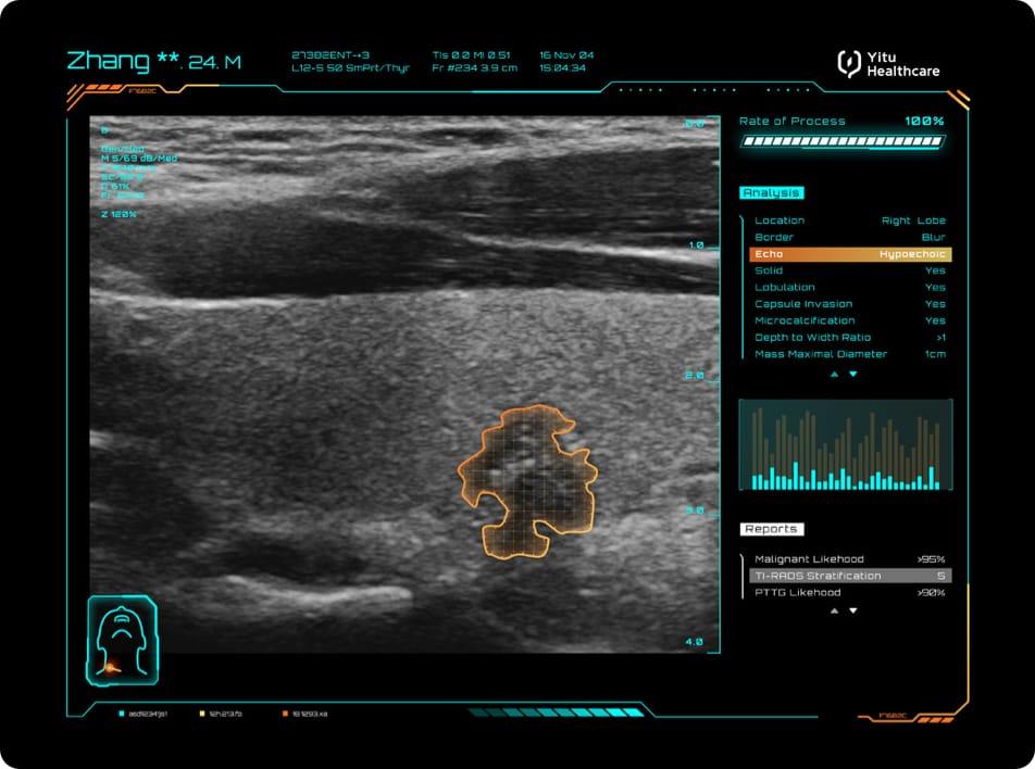 care.aiTM 甲狀腺超聲智能診斷系統